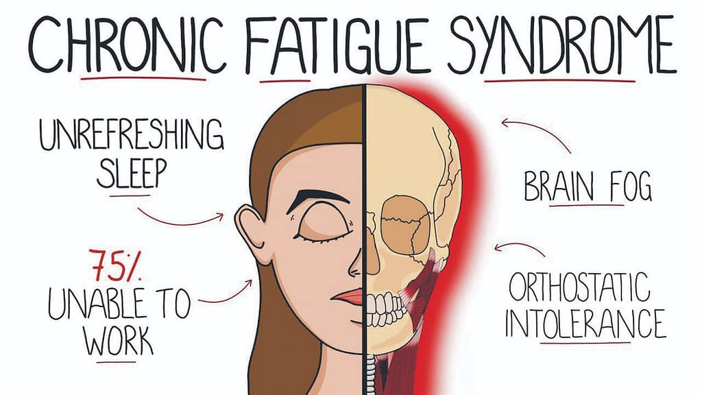 chronic-fatigue-syndrome
