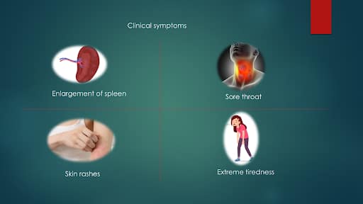 infectious mononucleosis
