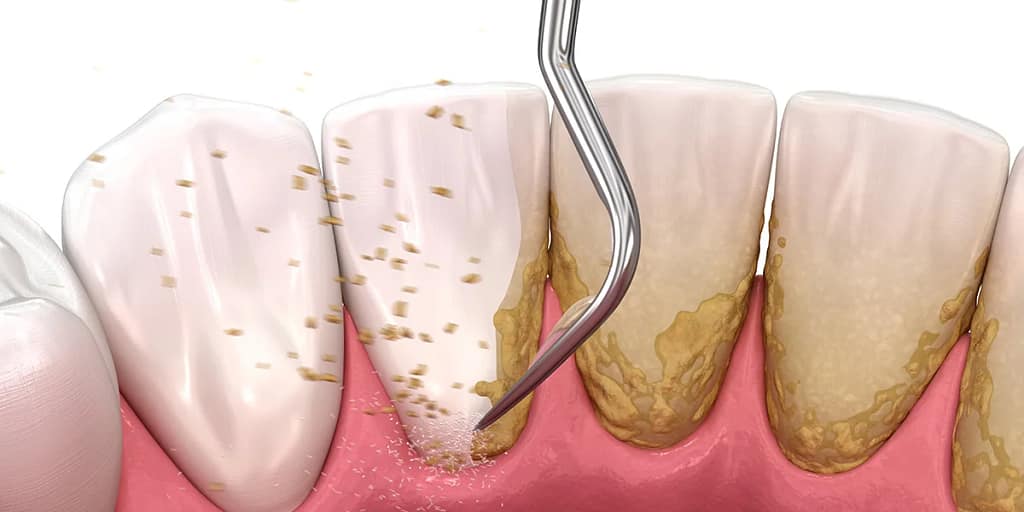 dental injury
