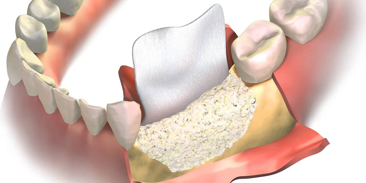veneers