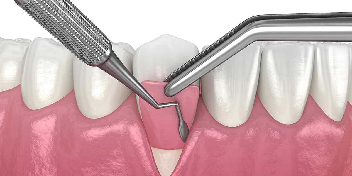 invisalign