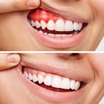 tooth extraction near me