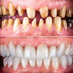 replacement tooth cost