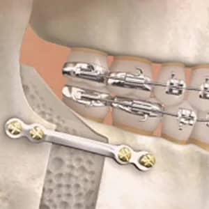 tooth extraction near me