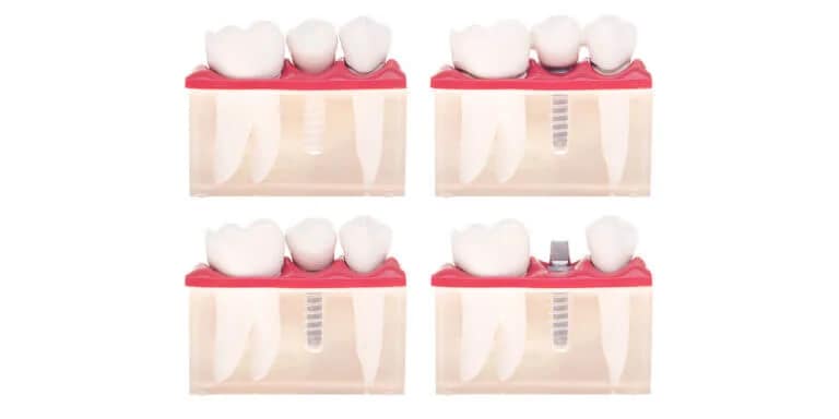 root canal retreatment
