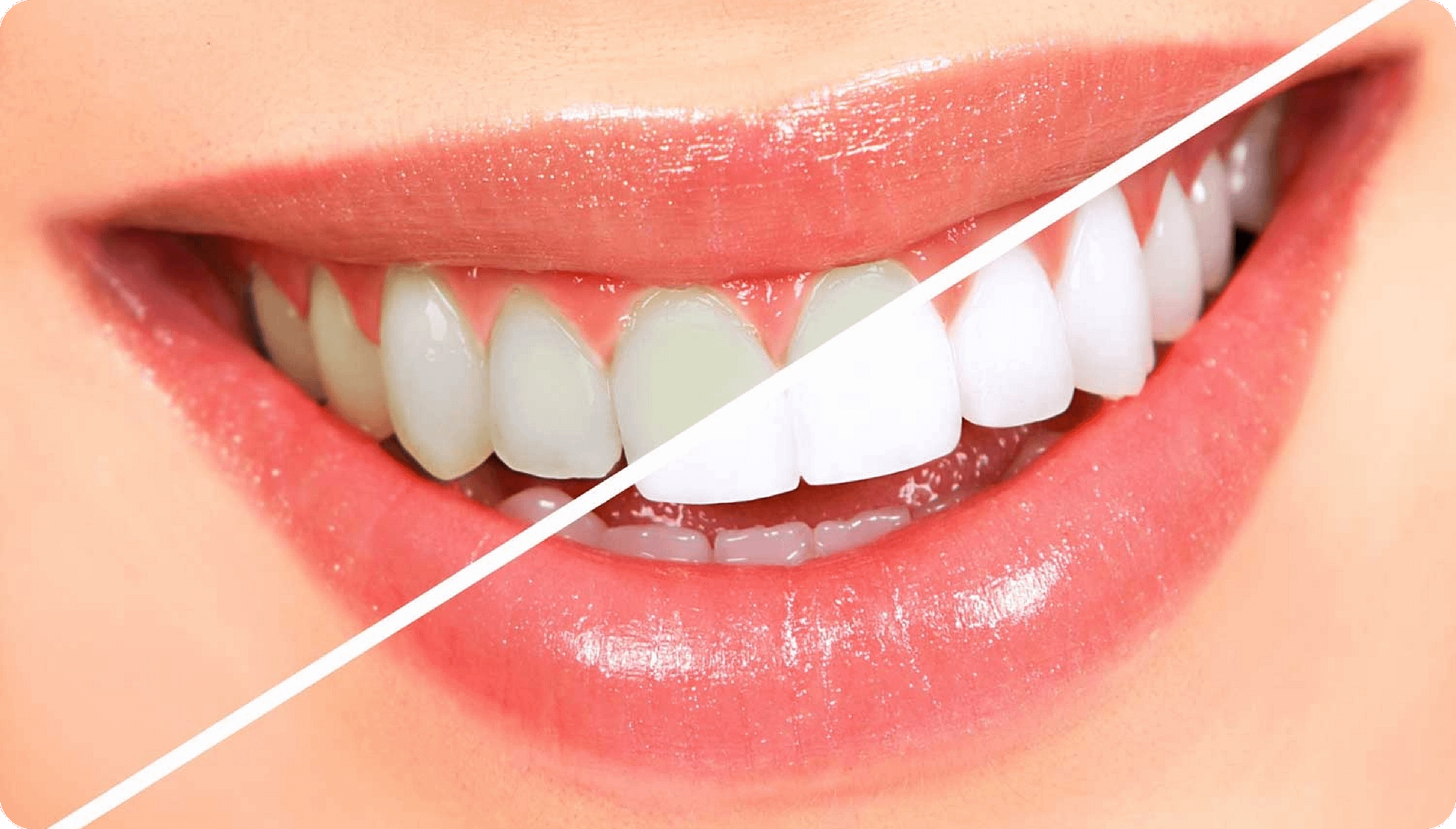 Teeth Whitening_Banner Image 01.jpg google