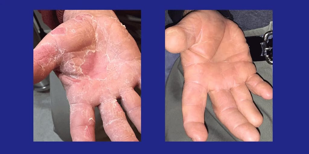 fungus-on-the-hands-blog