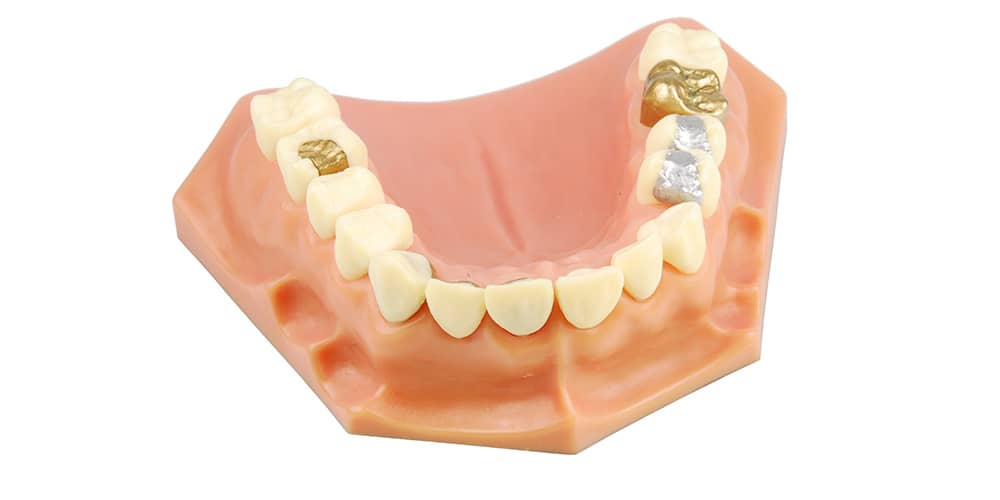 dental crowns