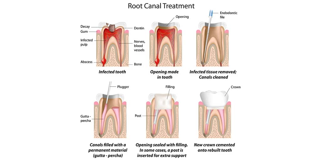 tooth bone graft