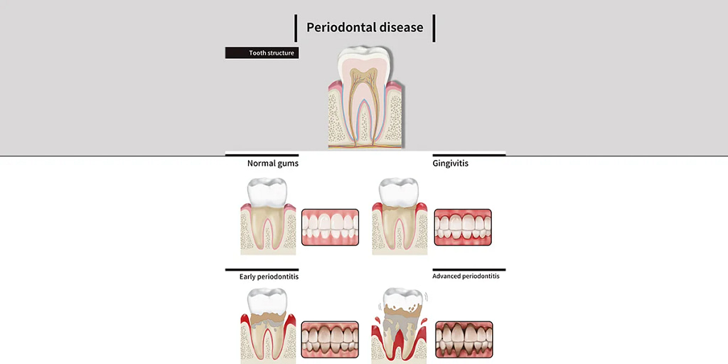 tooth bone graft