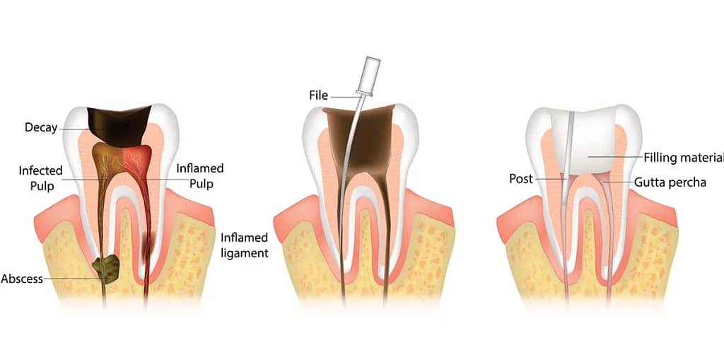 dental implants