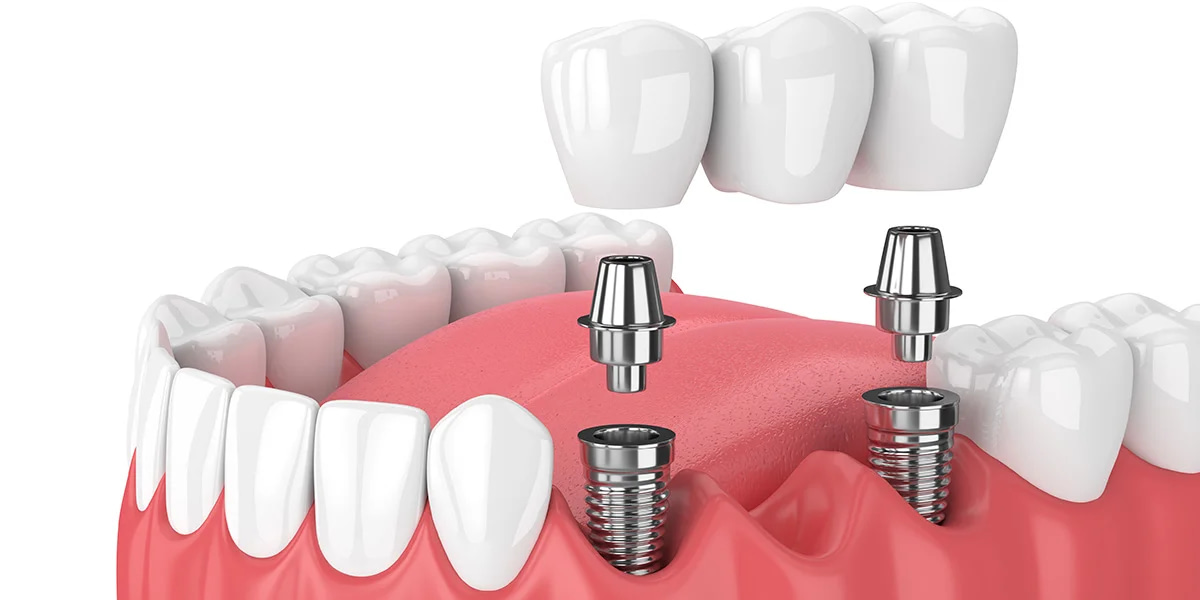 root canal retreatment