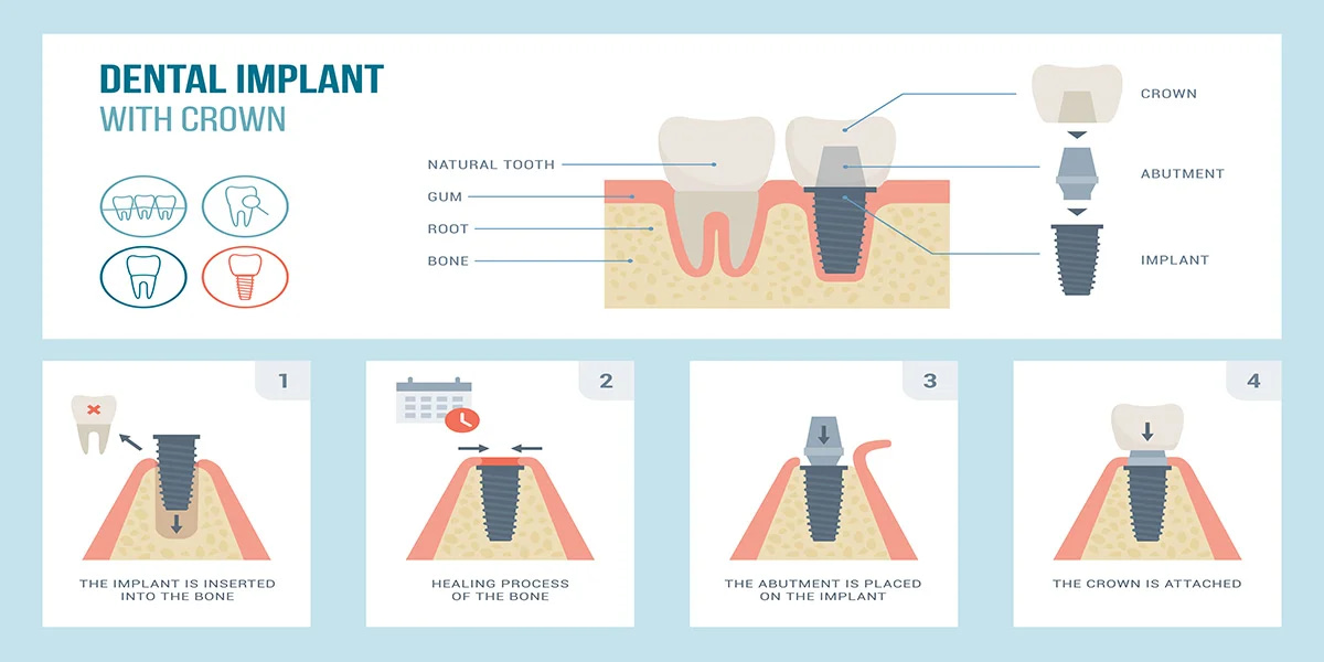 dental bridges