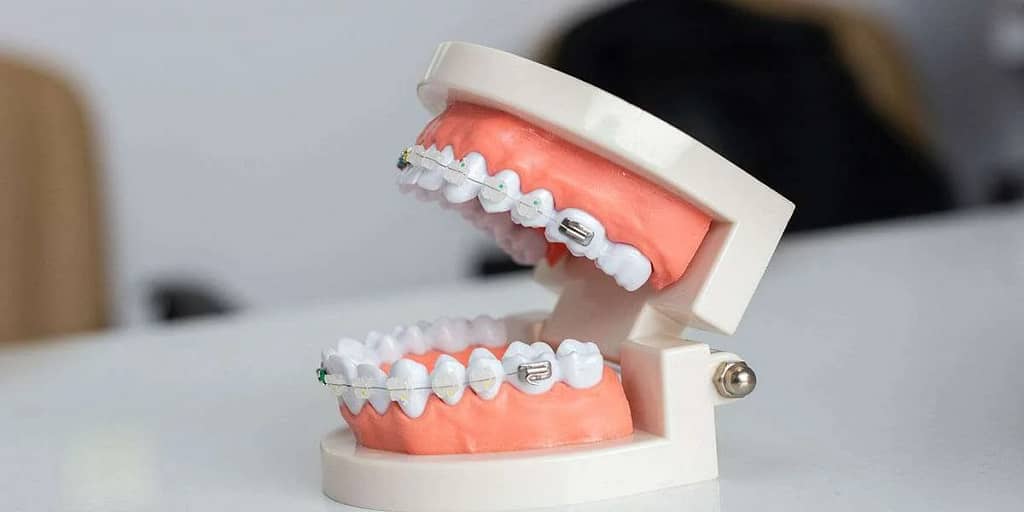 Cosmetic Dentist in Pinner: Invisalign Teeth Braces Pinner