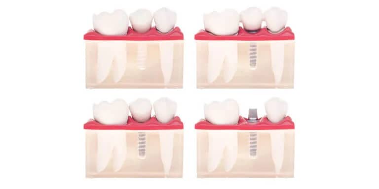 root canal retreatment