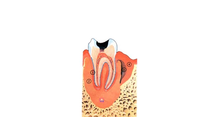 root canal retreatment